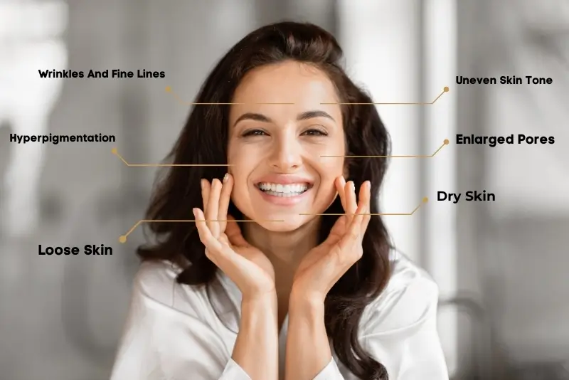 Smiling woman showing skin concerns treated by HydraFacial including fine lines, hyperpigmentation, dry skin, enlarged pores, and uneven tone